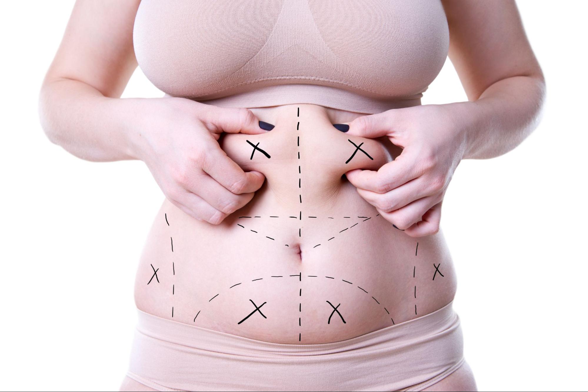 A Liposuction Procedure Promises 6-Pack Abs Without Lifting a Finger