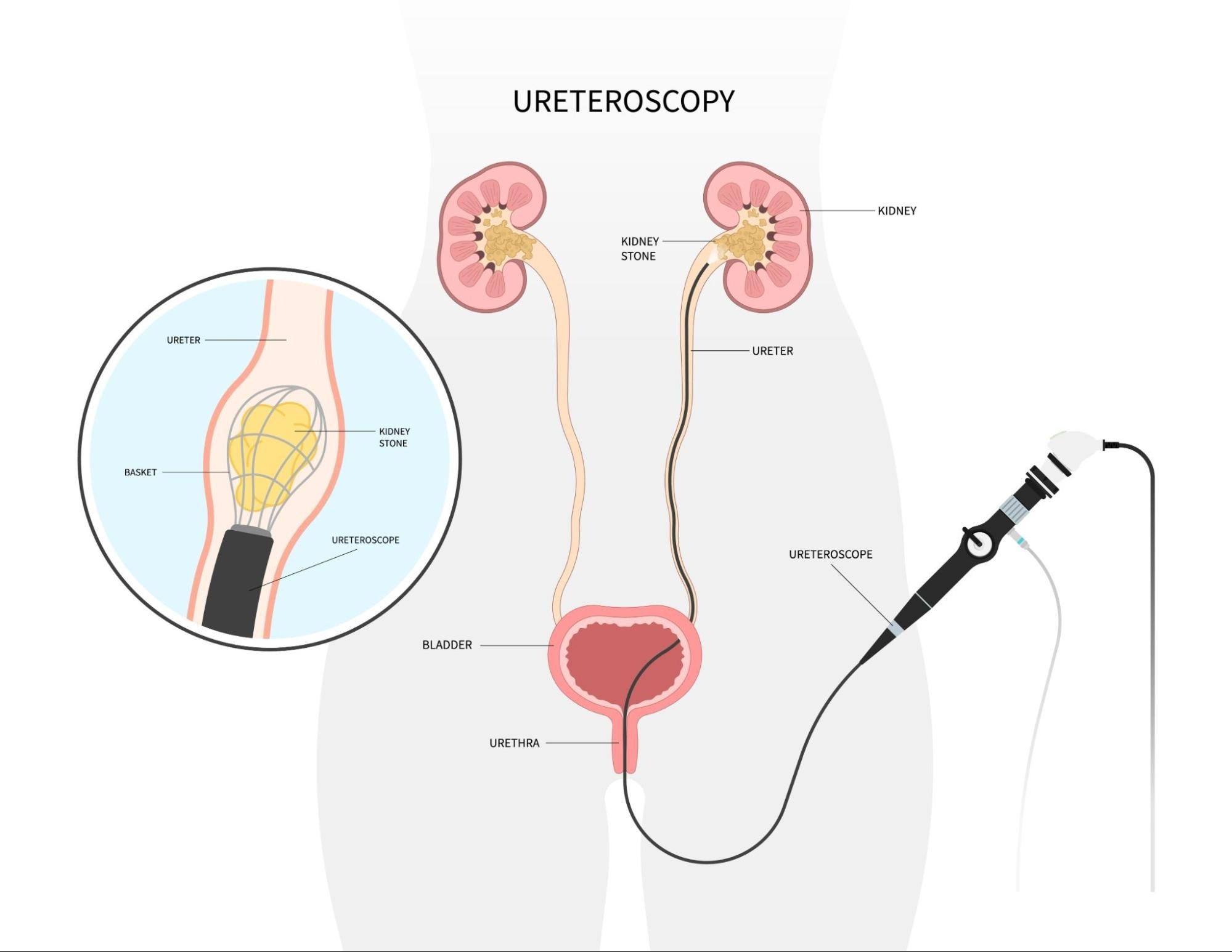 Ureteroscopy: Non-invasive Treatment for Kidney Stones