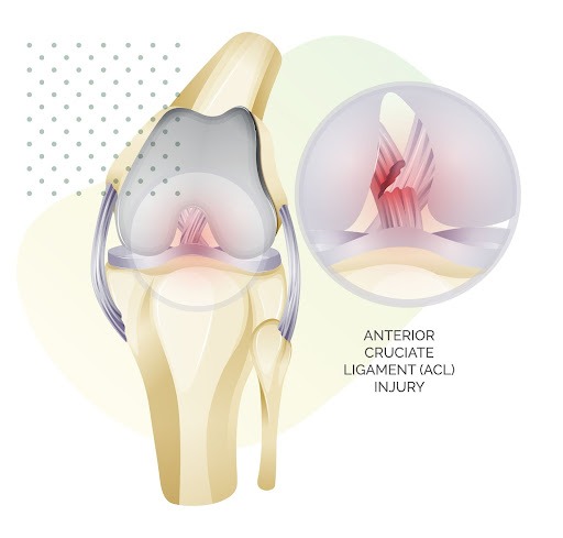 What is an ACL Injury