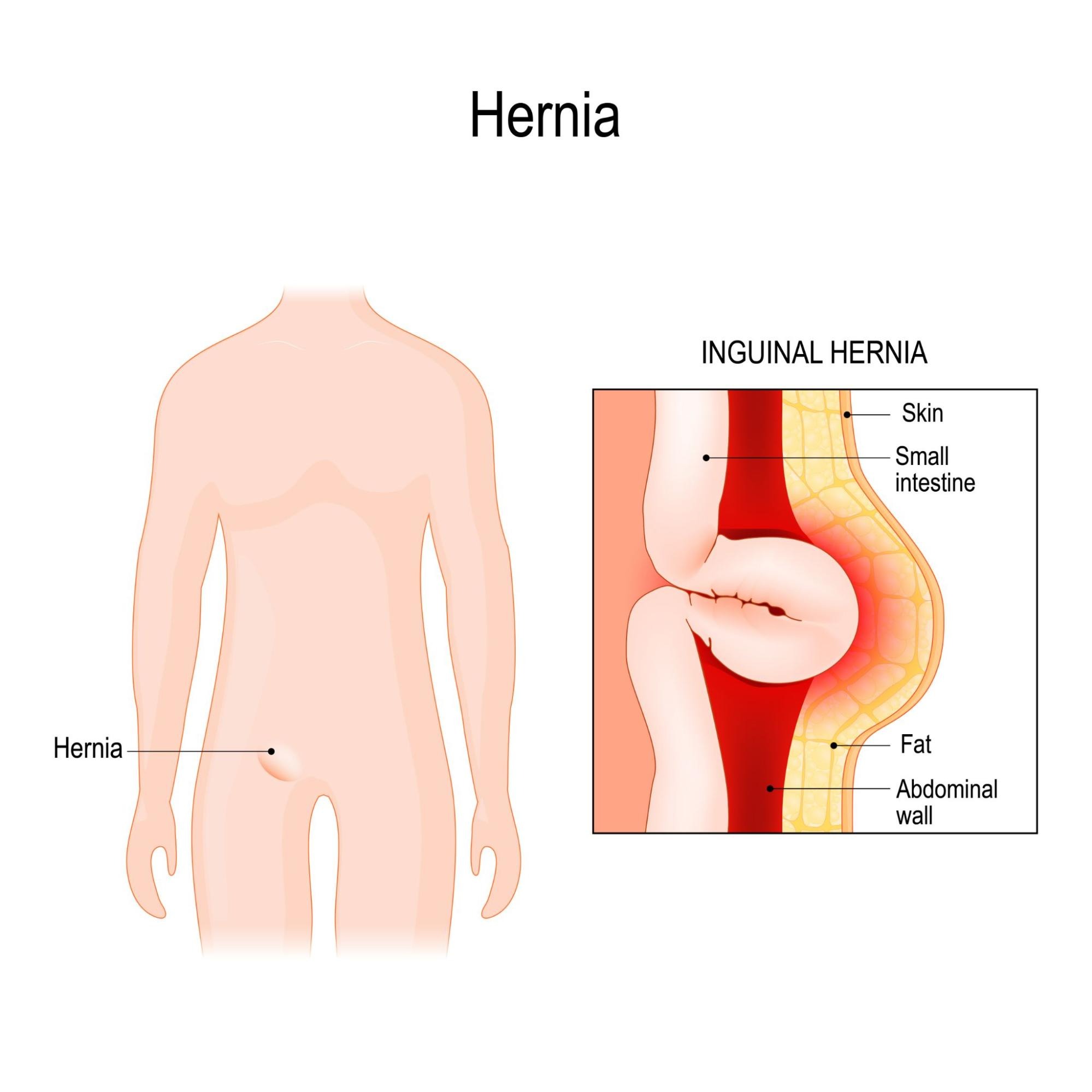 Which Doctor to Consult for Inguinal Hernia?