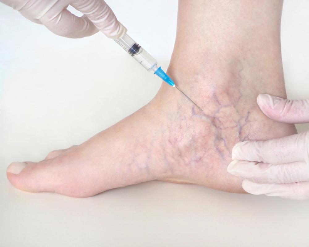 How Effective is Sclerotherapy for Varicose Veins?