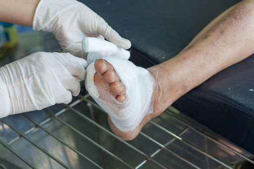 Navigating the Early Stages of Diabetic Foot Ulcers: Essential Information and Care Guidelines