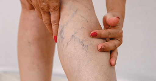 What Causes Blue Veins in Legs