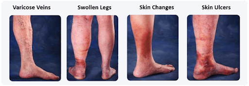 How Do Varicose Veins Affect the Skin