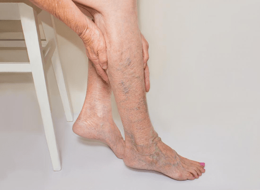 Can Varicose Veins be Cured?