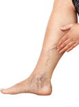 Inverse Varicose Veins in the Scrotum: How to Treat Them?