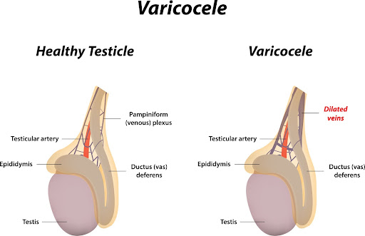 Can Hydrocele Cause Erectile Dysfunction? Exploring the Connection