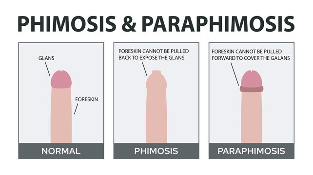Phimosis and Paraphimosis in Children
