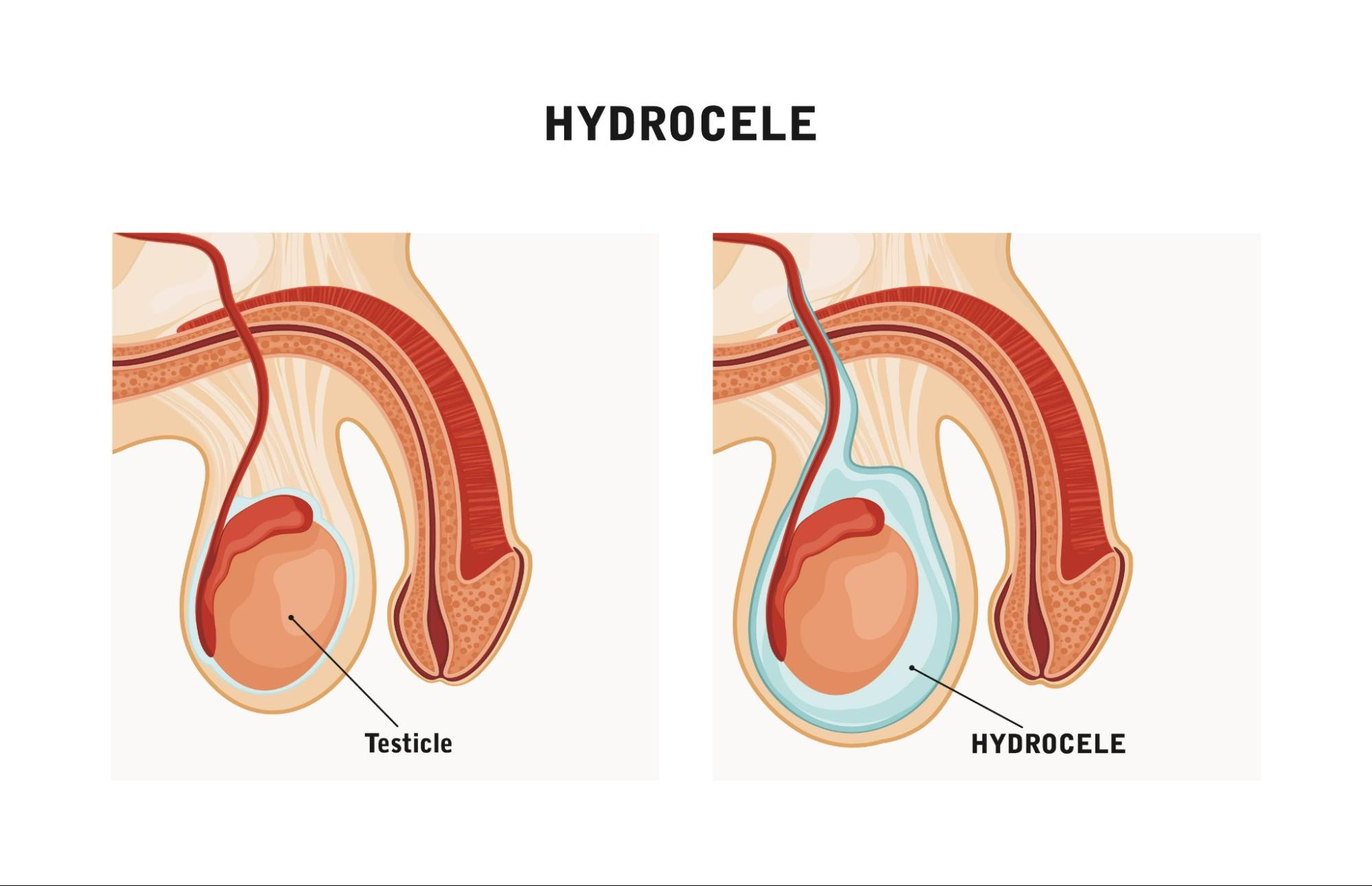 Treat Hydrocele Without Surgery