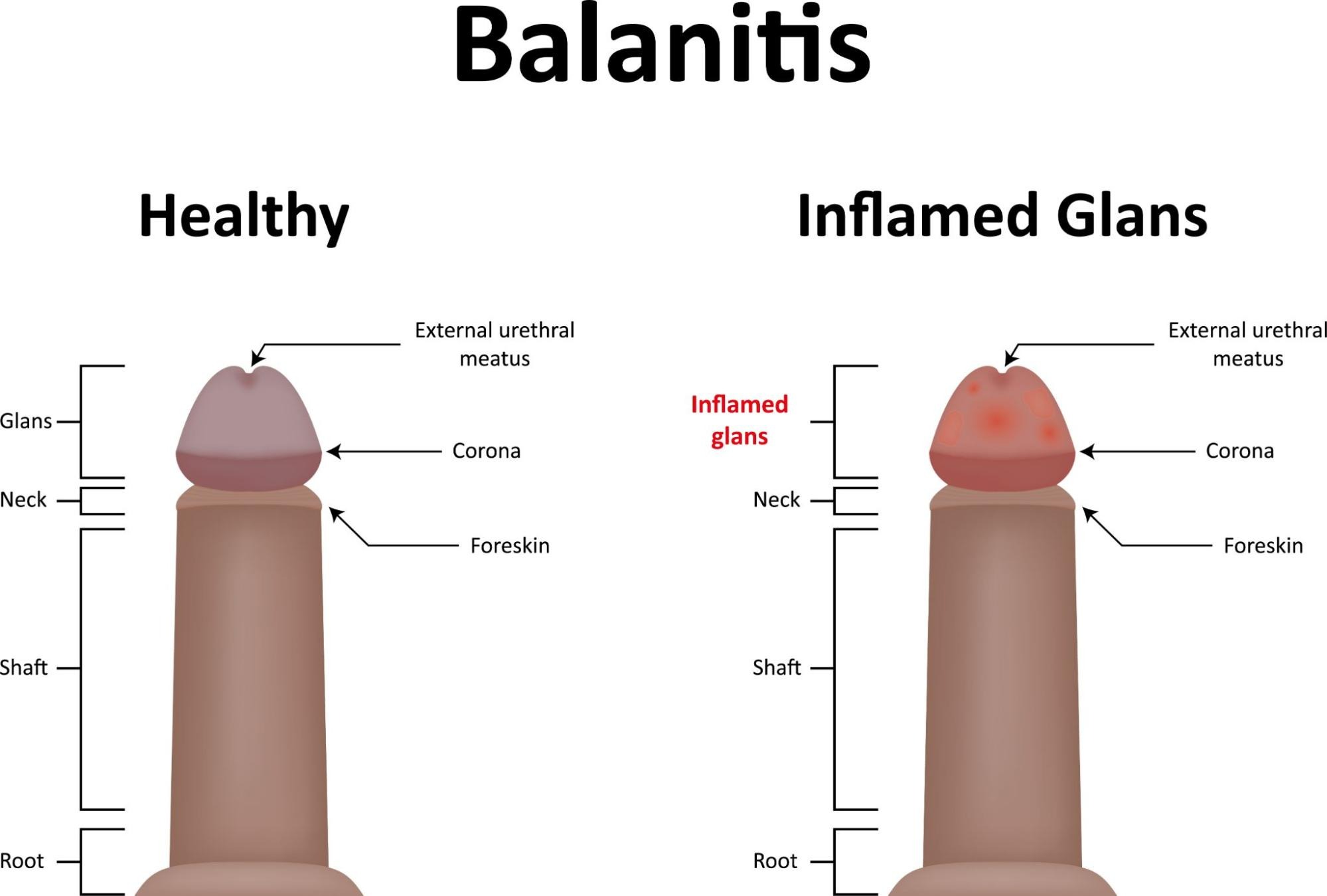 What Is The Permanent Treatment For Recurrent Balanitis?
