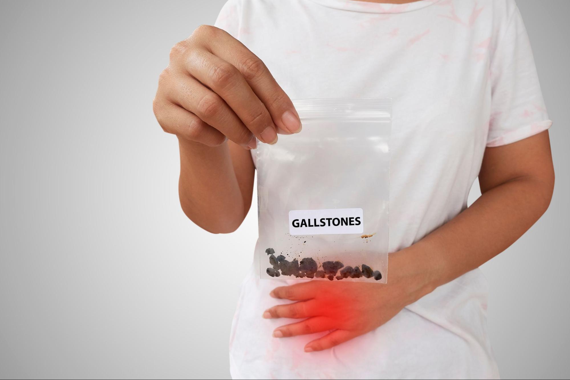 Gallbladder Stones: Navigating the Path to Treatment without Surgery