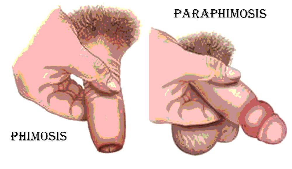 Phimosis and Paraphimosis in Children