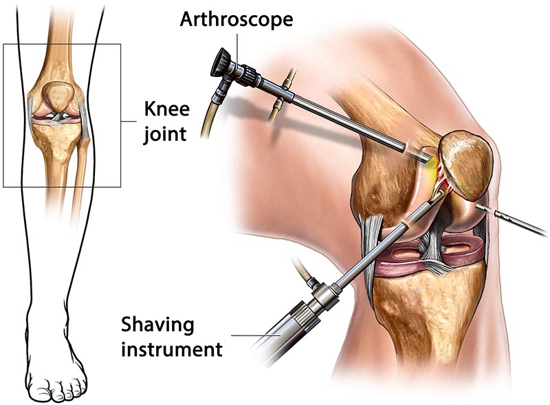 The Art of Precision: How Knee Arthroscopy Restores Functionality