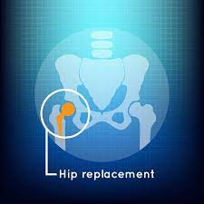 Total Hip Replacement Unveiled: Your Path to Improved Comfort