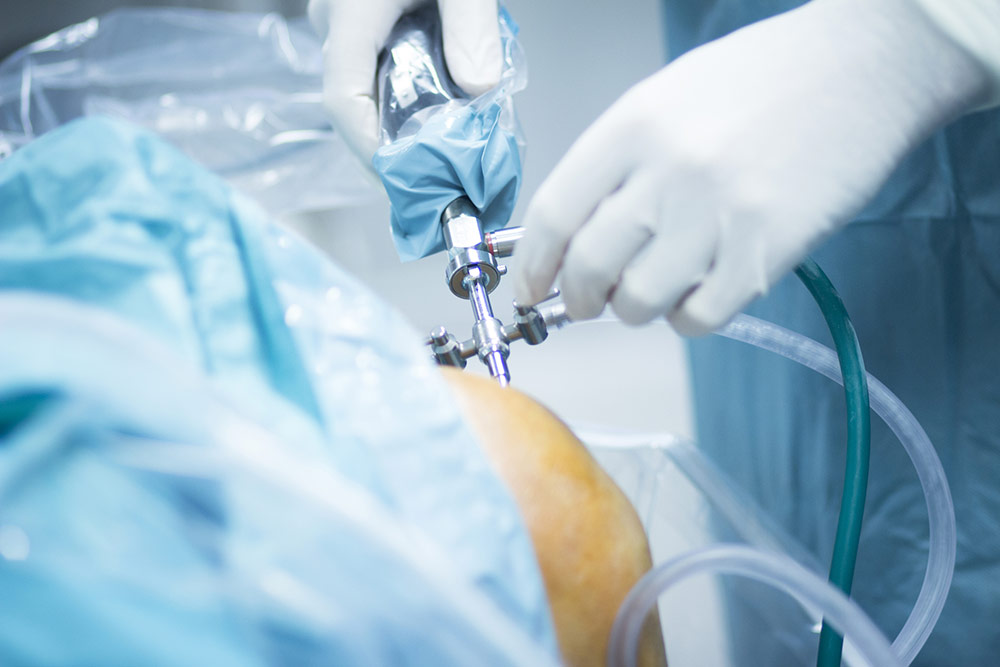 Surgical Precision: The Hidden Artistry of Minimally Invasive Arthroscopy