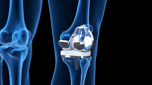 How to Choose the Right Knee Replacement Surgery for You