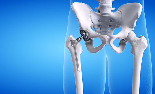 Hip Joint Replacement