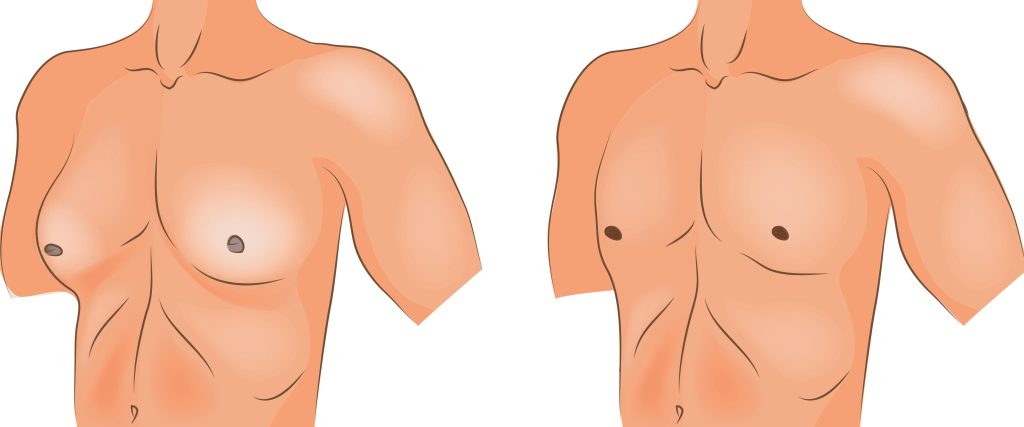 Difference between a normal male breast tissue and the other with gynecomastia